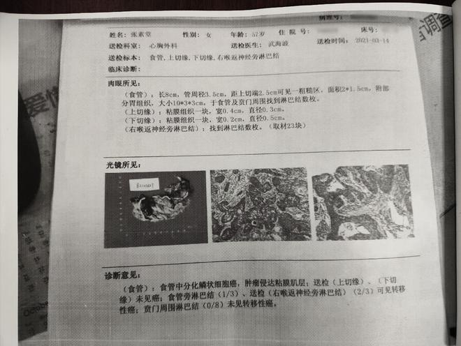 食管癌患者两个月后的惊人变化凯发入口医生都惊讶的转变：(图1)